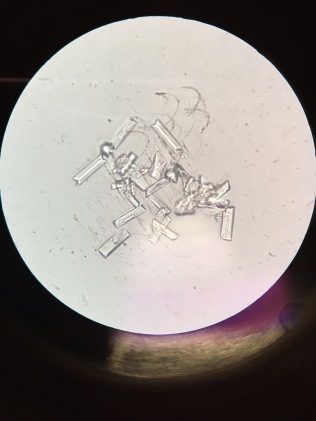 Struvite crystals found in urine.